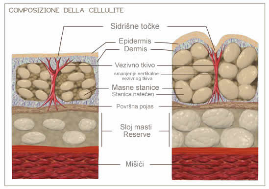 Composizione della cellulite