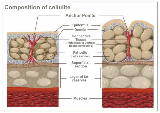 Composition of cellulite