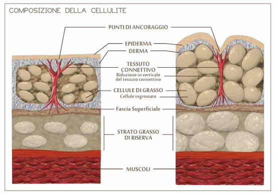 Composizione della cellulite